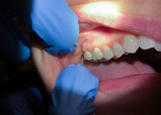 Best Emergency Broken Tooth Repair in Sweetser, IN